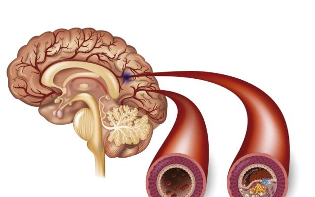 Tipos De Accidente Cerebrovascular