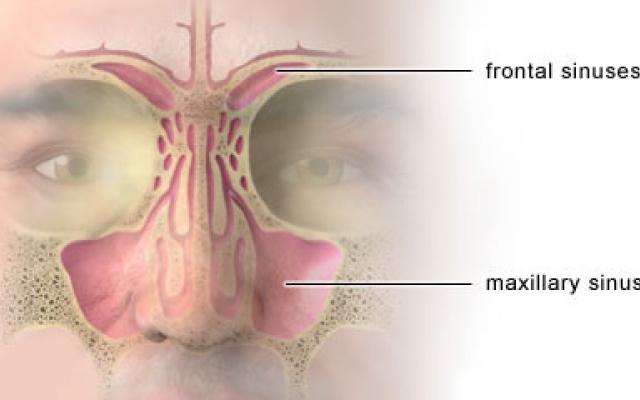 sinusitis