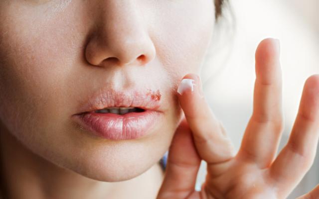 Mujer mostrando cómo prevenir el herpes labial.