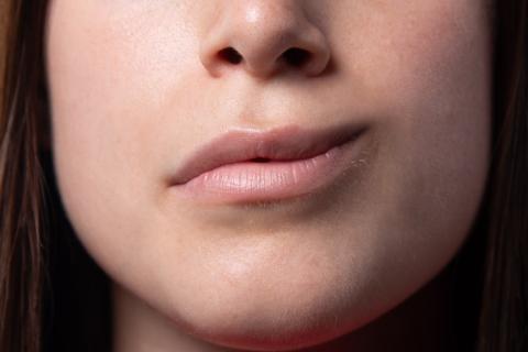 Mujer con la boca torcida, un síntoma para prevenir el ictus.